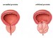 prostata_1_400x.jpg
